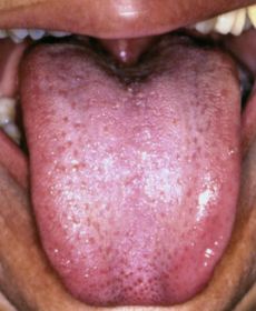 Clean tongue